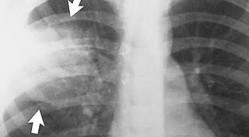Optimiser l&#039;utilisation des corticostéroïdes pour le traitement de la pneumonie