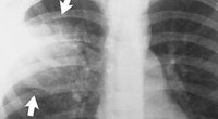 Optimiser l'utilisation des corticostéroïdes pour le traitement de la pneumonie