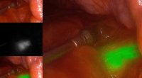 Nouvelle approche pour des biopsies plus précises des nodules pulmonaires