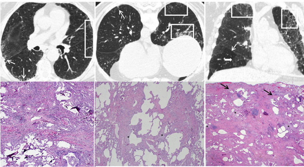 Identification précoce de la fibrose pulmonaire idiopathique à partir de modèles de tomodensitométrie iUIP